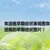 食道癌早期症状表现图食道（食道癌的早期症状图片）